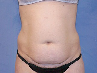 Tummy Tuck (Abdominoplasty)