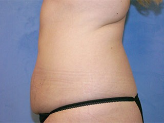 Tummy Tuck (Abdominoplasty)