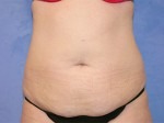 Tummy Tuck (Abdominoplasty)