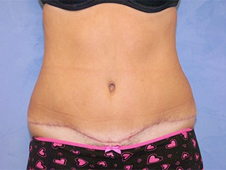 Tummy Tuck (Abdominoplasty)