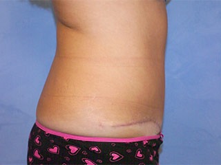 Tummy Tuck (Abdominoplasty)