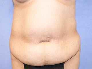 Tummy Tuck (Abdominoplasty)