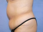 Tummy Tuck (Abdominoplasty)