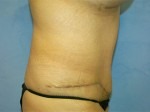 Tummy Tuck (Abdominoplasty)