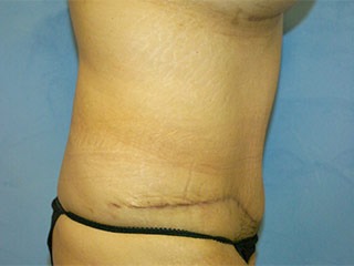 Tummy Tuck (Abdominoplasty)