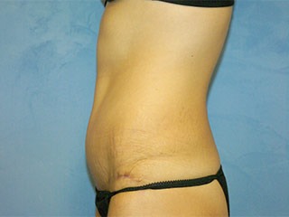 Tummy Tuck (Abdominoplasty)