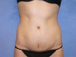 Tummy Tuck (Abdominoplasty)