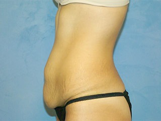 Tummy Tuck (Abdominoplasty)