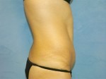 Tummy Tuck (Abdominoplasty)