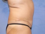 Tummy Tuck (Abdominoplasty)