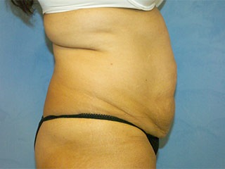 Tummy Tuck (Abdominoplasty)