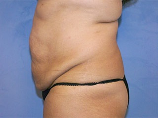 Tummy Tuck (Abdominoplasty)