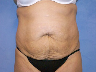 Tummy Tuck (Abdominoplasty)