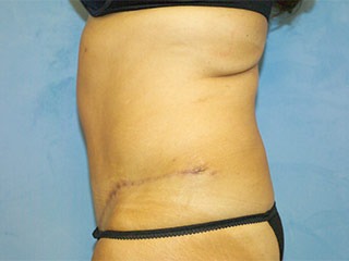 Tummy Tuck (Abdominoplasty)