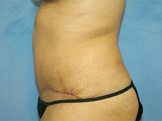 Tummy Tuck (Abdominoplasty)