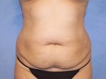 Tummy Tuck (Abdominoplasty)