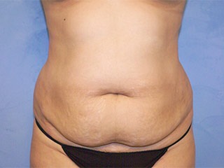 Tummy Tuck (Abdominoplasty)