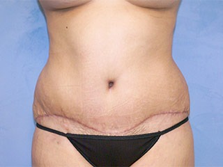 Tummy Tuck (Abdominoplasty)