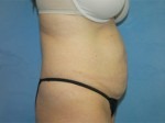 Tummy Tuck (Abdominoplasty)