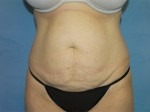 Tummy Tuck (Abdominoplasty)