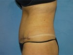 Tummy Tuck (Abdominoplasty)