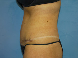 Tummy Tuck (Abdominoplasty)