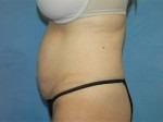 Tummy Tuck (Abdominoplasty)