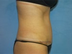 Tummy Tuck (Abdominoplasty)