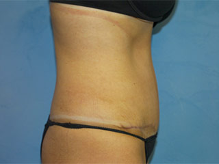 Tummy Tuck (Abdominoplasty)