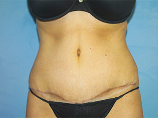 Tummy Tuck (Abdominoplasty)