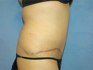 Tummy Tuck (Abdominoplasty)