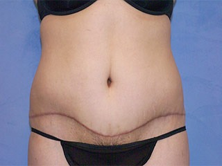 Tummy Tuck (Abdominoplasty)