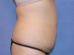 Tummy Tuck (Abdominoplasty)