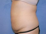 Tummy Tuck (Abdominoplasty)