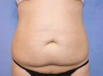 Tummy Tuck (Abdominoplasty)