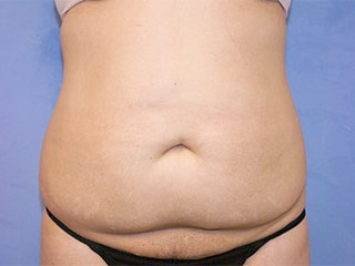 Tummy Tuck (Abdominoplasty)