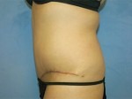 Tummy Tuck (Abdominoplasty)