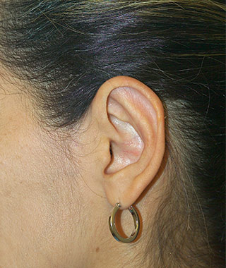 Ear Surgery (Otoplasty)