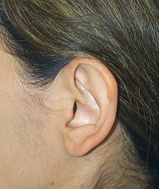 Ear Surgery (Otoplasty)