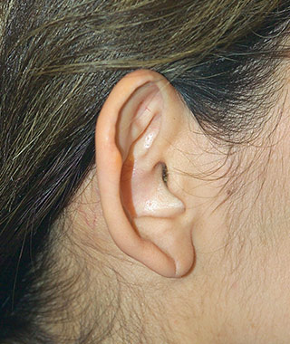 Ear Surgery (Otoplasty)