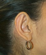 Ear Surgery (Otoplasty)