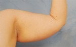 Arm Lift (Brachioplasty)