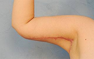 Arm Lift (Brachioplasty)