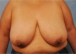 Breast Reduction ( Reduction Mammoplasty)