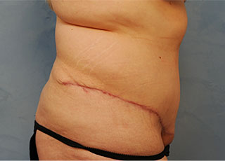 Tummy Tuck (Abdominoplasty)