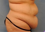 Tummy Tuck (Abdominoplasty)