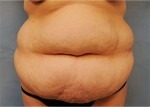 Tummy Tuck (Abdominoplasty)