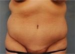 Tummy Tuck (Abdominoplasty)