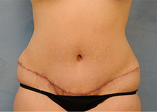 Tummy Tuck (Abdominoplasty)