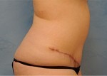 Tummy Tuck (Abdominoplasty)